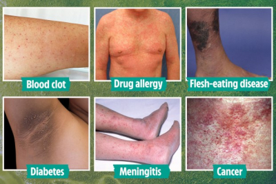 Lifesaving Awareness: Identifying Dangerous Rashes from Cancer to Meningitis